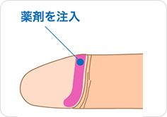 注入治療で亀頭増大を実現