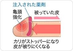 亀頭増大術にはこんなメリットも！