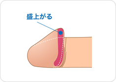 亀頭増大術