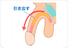 切らない長茎術とは